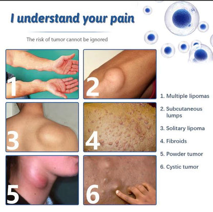 Doctor's No 1 choice | Lipoma Removal Cream (Pack of 1)